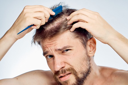 درمان ریزش مو در مردان, راههای درمان ریزش مو, ریزش مو بعد از کاشت