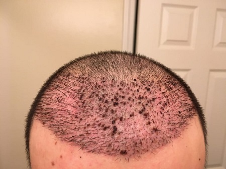 دست زدن به موهای کاشته شده, علائم عفونت بعد از کاشت مو, عوارض کاشت مو