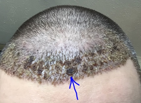 علائم عفونت بعد از کاشت مو, عوارض کاشت مو, علت دلمه های پس از کاشت مو