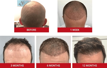 عکس عفونت بعد از کاشت مو , عفونت بعد از کاشت مو , درمان عفونت بعد از کاشت مو 