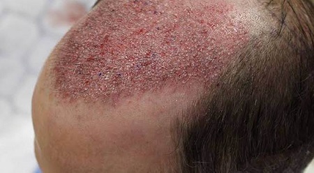 درمان عفونت بعد از کاشت مو , علائم عفونت بعد از کاشت مو , عفونت پوست سر بعد از کاشت مو