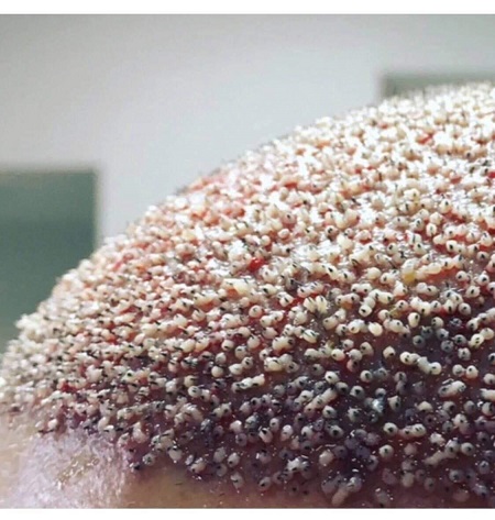 عفونت پوست سر بعد از کاشت مو , پیشگیری از عفونت بعد از کاشت مو , نشانه های عفونت بعد از کاشت مو