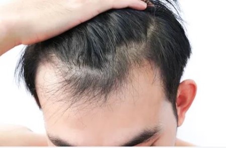 روش غیر دارویی برای درمان ریزش مو