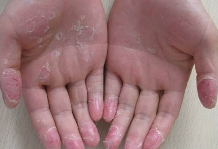 عوامل پوست پوست شدن دست, علت پوست پوست شدن دست کودک, درمان خانگی پوست پوست شدن دست
