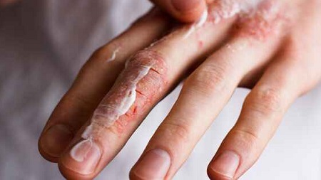 پوست پوست شدن دست و پا, علت پوست شدن دست, علت اصلی پوسته شدن انگشتان دست