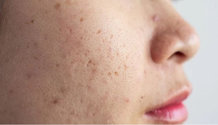 بهترین ماسک خانگی برای جای جوش و کک و مک