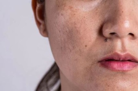 بهترین ماسک خانگی برای جای جوش و کک و مک
