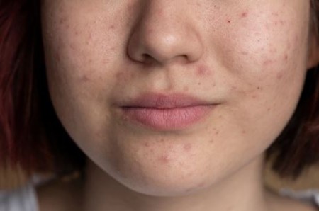 بهترین ماسک خانگی برای جای جوش و کک و مک