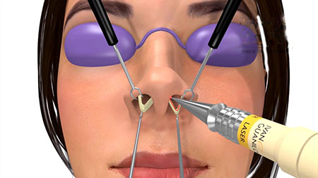 جراحی بینی بسته, جراحی بینی به روش بسته, کوچک کردن بینی با لیزر