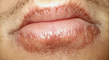 علت دانه های سفید روی لب بعد از تزریق ژل, عفونت لب بعد از تزریق ژل, پیشگیری از عفونت لب بعد تزریق ژل