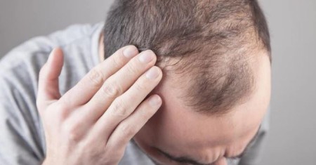 ایا تب مالت باعث ریزش مو میشود