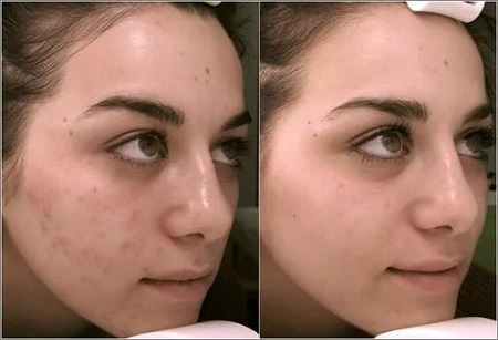 ماندلیک اسید, ماندلیک اسید برای پوست, قبل و بعد از استفاده از ماندلیک اسید روی پوست