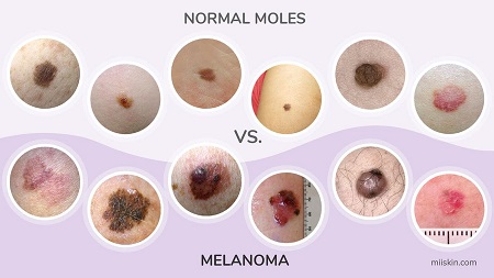  سرطان پوست ملانوما, بیماری ملانوما, نمونه هایی از بیماری ملانوما