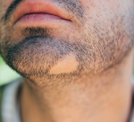 علت ریزش ریش صورت, علت ریزش ریش و سبیل, درمان ریزش ریش و سبیل در آقایان