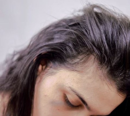 ریزش مو و تأثیر استرس بر سلامت مو