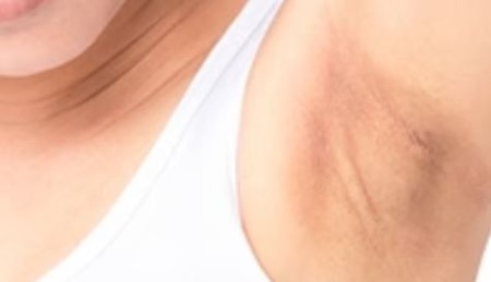 روش‌های درمانی تیرگی زیر بغل و کشاله ران