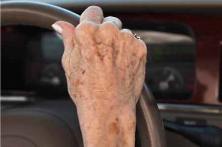 لک هورمونی یا ملاسما