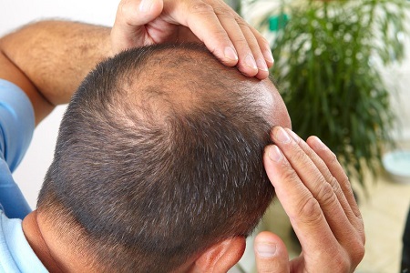 کاشت مو طبیعی از ناحیه تناسلی, مراحل کاشت مو از ناحیه تناسلی, مراقبت های بعد از کاشت مو