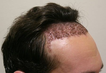 کاشت مو از ناحیه تناسلی, عوارض کاشت مو از ناحیه تناسلی, جدیدترین روش کاشت مو