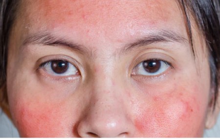 درمان لکه های قرمز روی پوست صورت, علت قرمزی پوست صورت,قرمزی صورت نشانه چیست