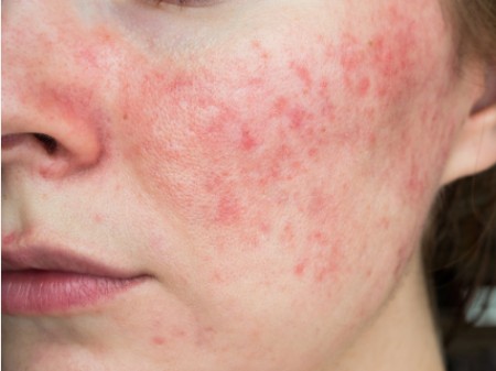 درمان لکه های قرمز روی پوست صورت, علت قرمزی پوست صورت,علت قرمز شدن صورت