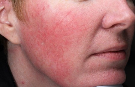 درمان لکه های قرمز روی پوست صورت, علت قرمزی پوست صورت,قرمزی پوست صورت از چیست