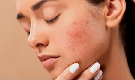 از بین بردن جوش برای همیشه