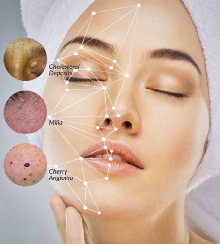 ترمیم ناهمواریهای پوست, درمان ناهمواری های پوستی با لیزر, راههای درمان ناهمواری های پوست