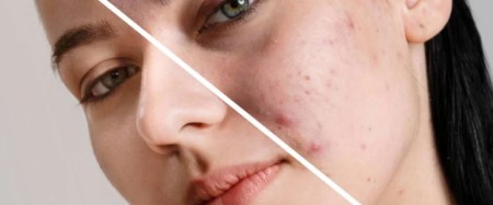 مصرف غذاهای مفید برای پوست حساس