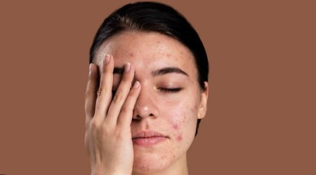 استفاده از کرم‌های ضدآفتاب مناسب برای پوست های حساس