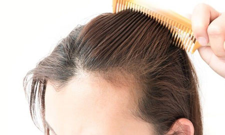 ریزش طبیعی مو, چقدر ریزش مو طبیعی است, چه میزانی از ریزش مو طبیعی است