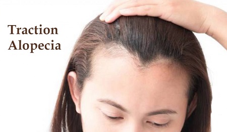 پیشگیری از آلوپسی کششی, جلوگیری از ریزش مو کششی, درمان ریزش موی کششی