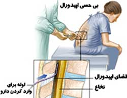 زایمان طبیعی,زایمان طبیعی بدون درد