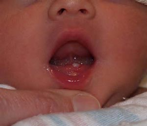 دندان نوزاد,نوزادانی که موقع تولد دندان دارند