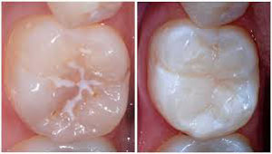 پوسیدگی دندان کودکان,پیشگیری از پوسیدگی دندان کودکان