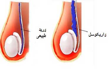 ناباروری,علت ناباروری,درمان ناباروری