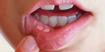 درمان زخم دهانی,علت زخم دهانی کودک
