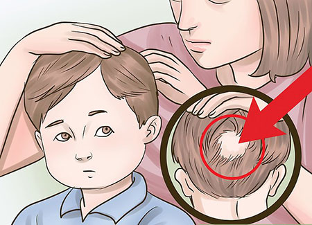 علت ریزش مو در کودکان,ریزش مو در کودکان,دلیل ریزش مو در کودکان