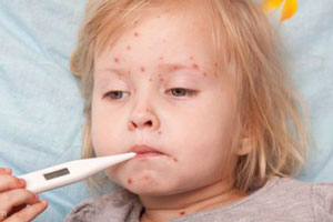 واکسناسیون کودک,درمان بیماری سرخک 