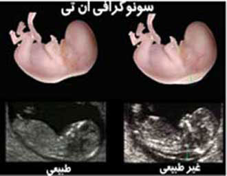 تست غربالگری در بارداری،انواع غربالگری های دوران بارداری