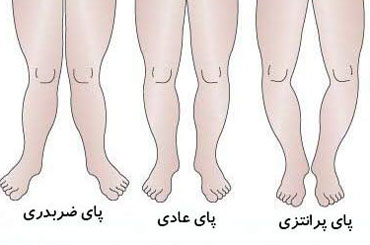 علت پای پرانتزی, علل پای پرانتزی