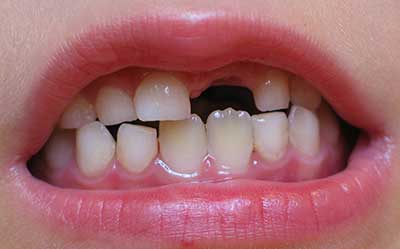 دندانهای دائمی کودکان