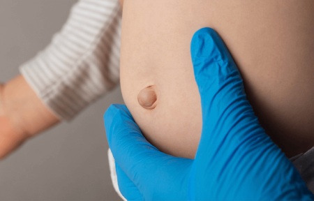 نفخ ناف نوزاد