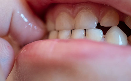 علت دندان قروچه کودکان,علت دندان قروچه کودک در خواب چیست