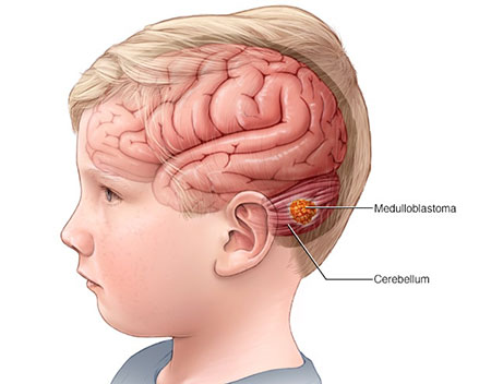 تومور مغزی در کودکان,دلایل تومور مغزی در کودکان,علائم تومور مغزی در کودکان