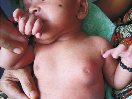 تورم پستان نوزاد , علت بزرگ شدن سينه کودک , برآمدگی سینه نوزاد از یک طرف 