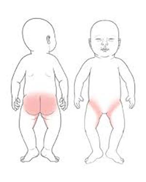 سوختگی پای نوزاد,درمان سوختگی پای نوزاد,پیشگیری سوختگی پای نوزاد