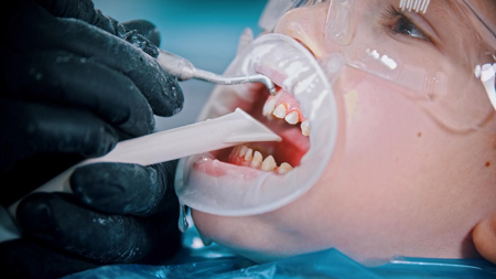 عوارض کشیدن دندان شیری, نحوه کشیدن دندان شیری, بعد از کشیدن دندان شیری چه بخوریم