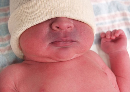 تشخیص سیانوز نوزادان, عوارض سیانوز در نوزادان, انواع سیانوز در نوزادان