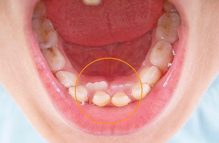  سندروم اهلرز دانلوس و دندان اضافی, دندان اضافه در کودکان, دندان اضافی و نهفته